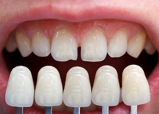 porcelain-veneers-2